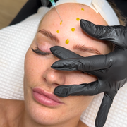 A beautiful Bio Re-Peel by beauty technicians at Preah Love